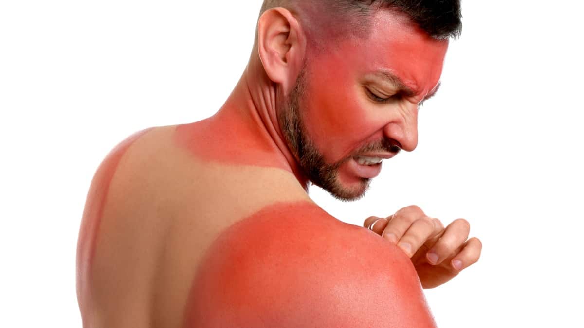 Cómo aliviar las quemaduras solares y tratar la piel irritada
