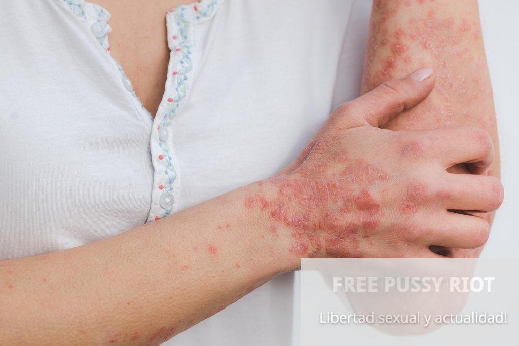 psoriasis