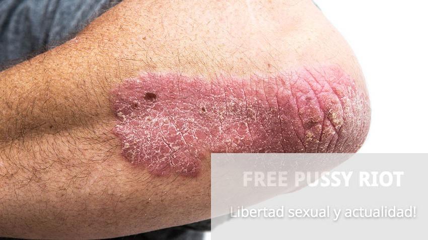 psoriasis